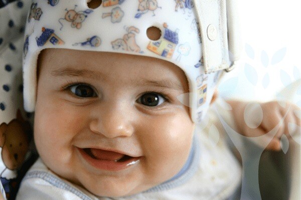 Torticollis Torticollis